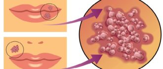 Герпес: причины, симптомы, факторы риска, диагностика и лечение