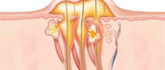 Фурункулез: причины, диагностика и методы лечения