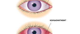 Бактериальный конъюнктивит: причины, диагностика и методы лечения